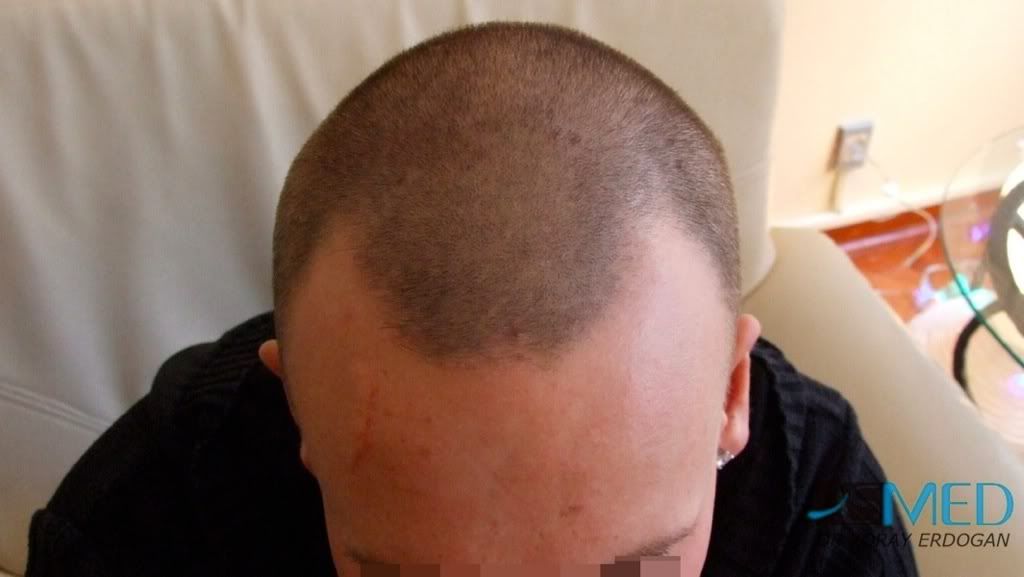 Dermatite atipica e atopic